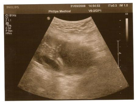 la main avec le pouce lever a 21 semaines