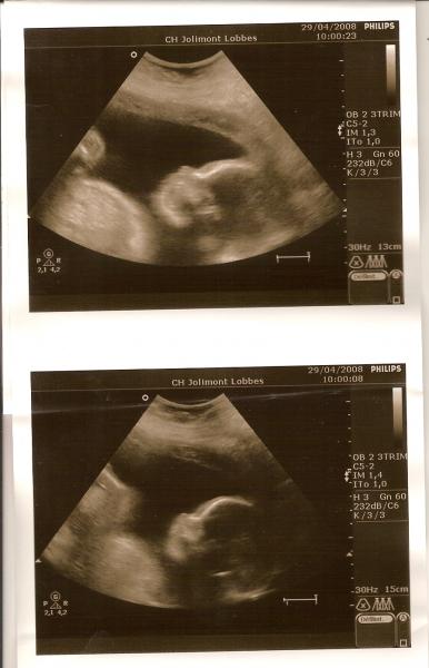 tracy � 24 semaines